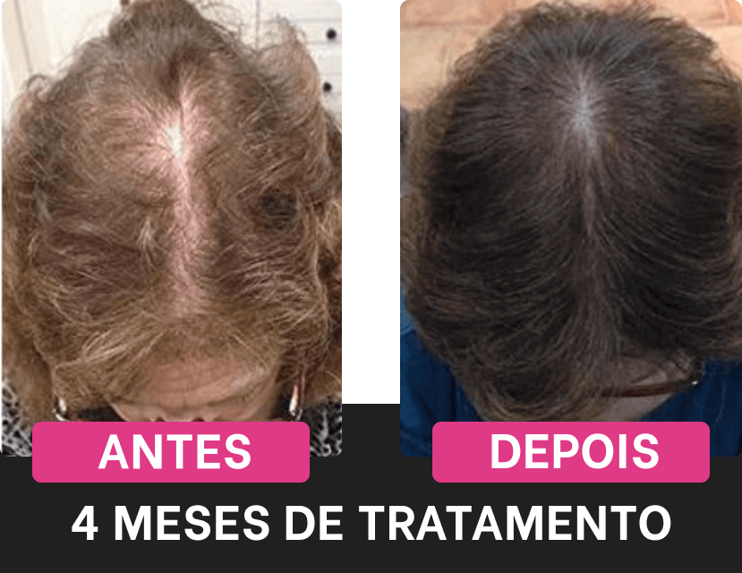 antes-depois-harmony-hair