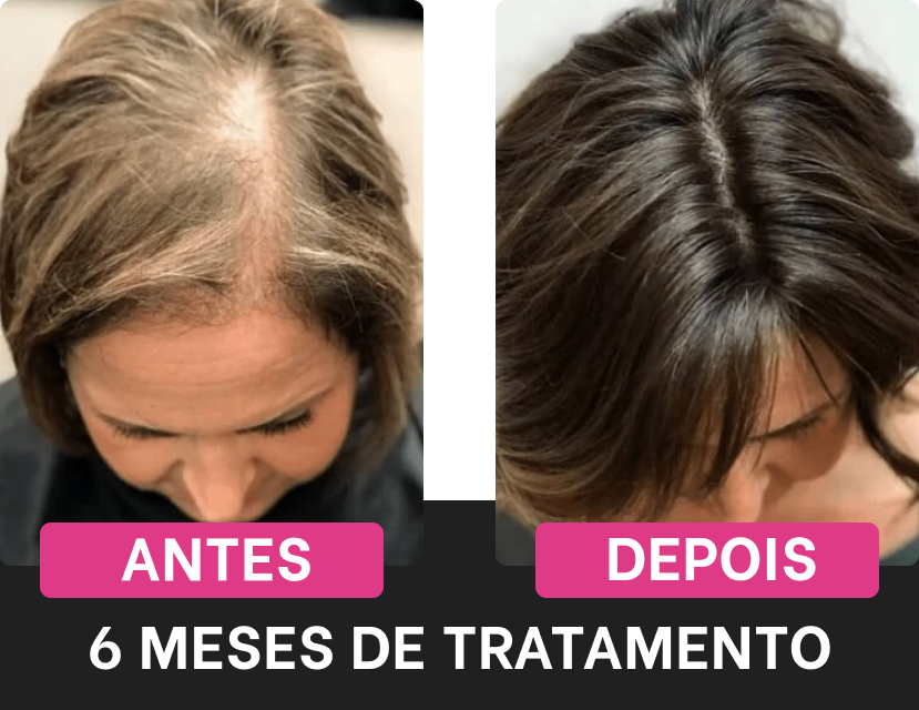 resultado harmony hair