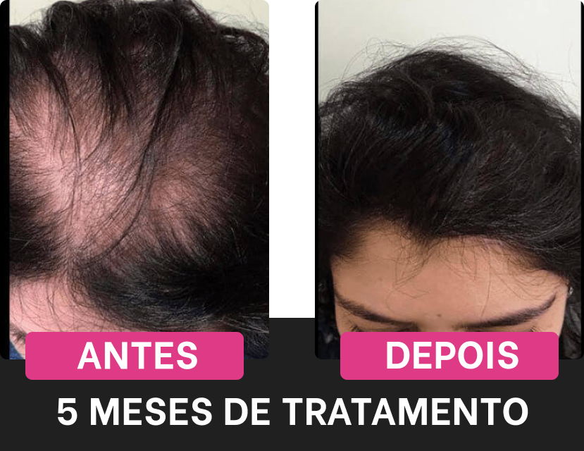 antes-depois-harmony-hair